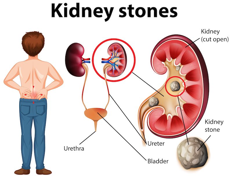 causes kidney stones