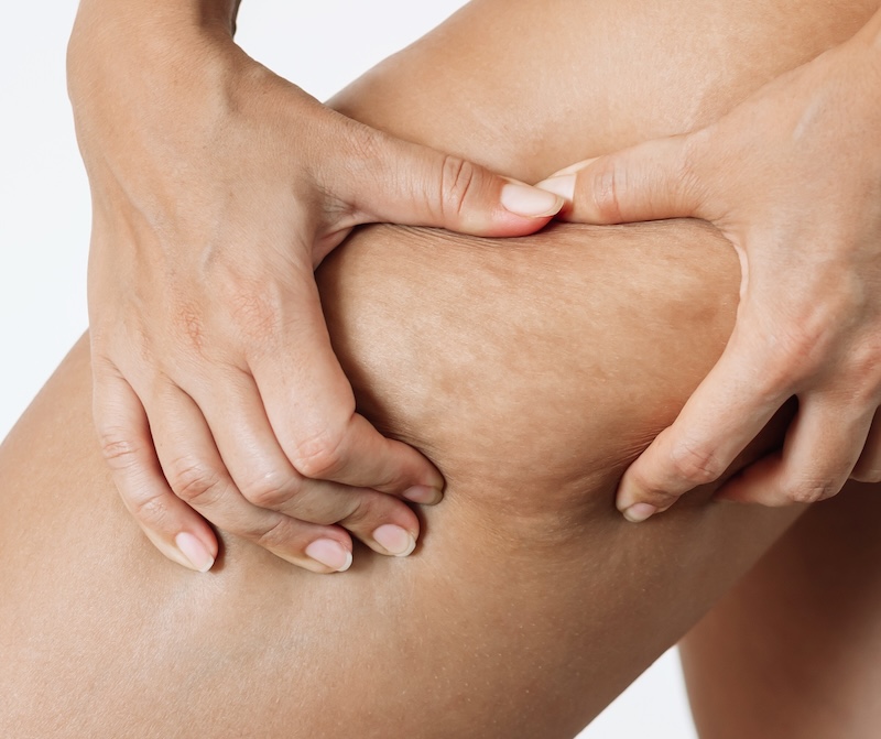causes cellulite