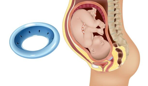 Cervical Band During Pregnancy